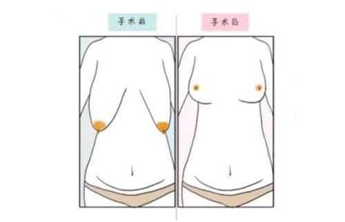 四、注射类隆鼻新选择：濡白天使实操成效拆解