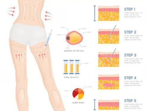 五、打瘦脸针的安心规范与风险应对