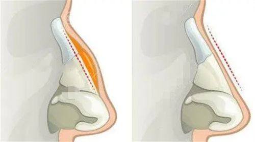 三、内双人群：从“隐双”到“亮眼”的视觉升级