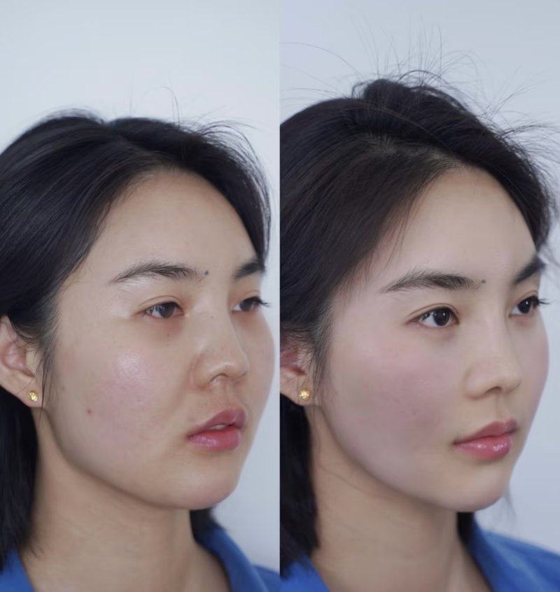 五、注射隆鼻用什么材料好？分需求精细匹配