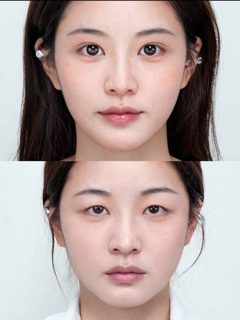 瘢痕增生期：化妆同时别忘抗疤