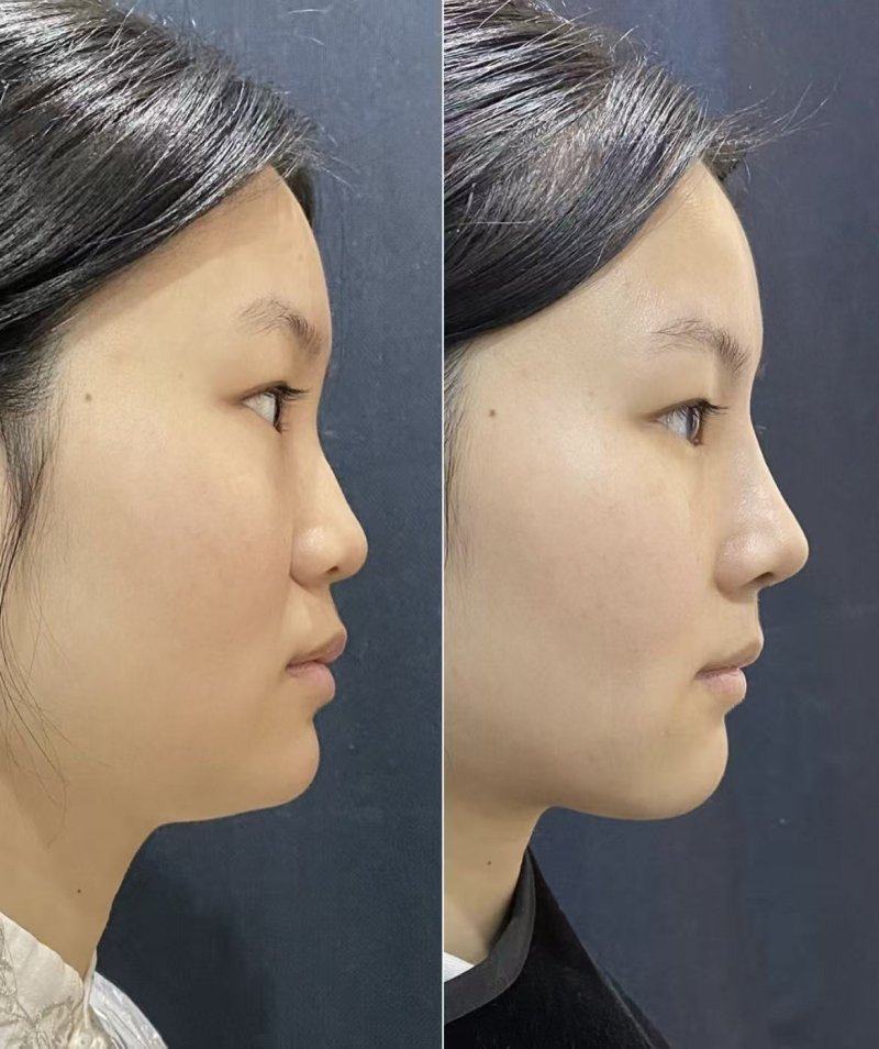 四、凹陷性疤痕（含10年以上旧疤、痘坑）：多维度填补+刺激胶原再生