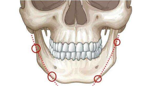 隆鼻有点歪能矫正吗？分阶段选矫正方案，附医生机构及修复价格参考