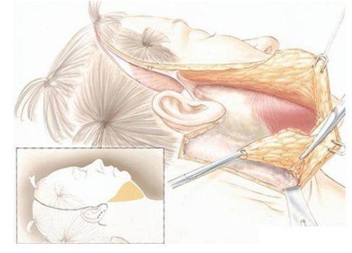 二、哪些疤痕适合通过手术改善