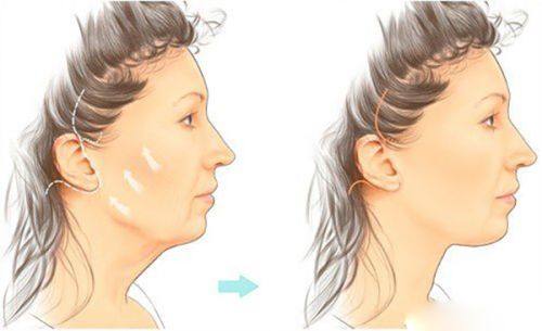 二、增生性疤痕（缝针疤、刀伤增生疤）的去除方案