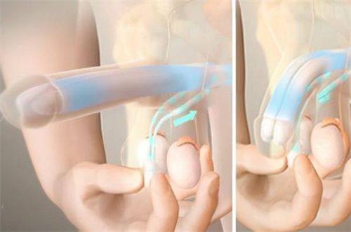 四、色素沉着型旧疤、轻度增生小疤、浅表外伤疤的改善方案