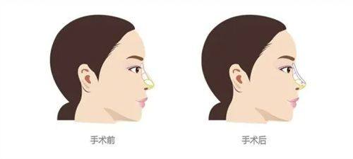 四、昆明地区歪鼻矫正机构及收费参考