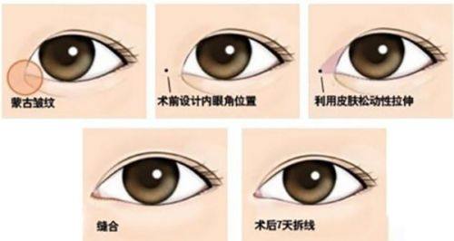 四、男生割双眼皮多少钱？手术方式、修复与真实体验参考