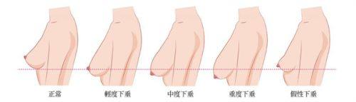 二、男生割双眼皮会奇怪吗？专属设计要点帮你避坑