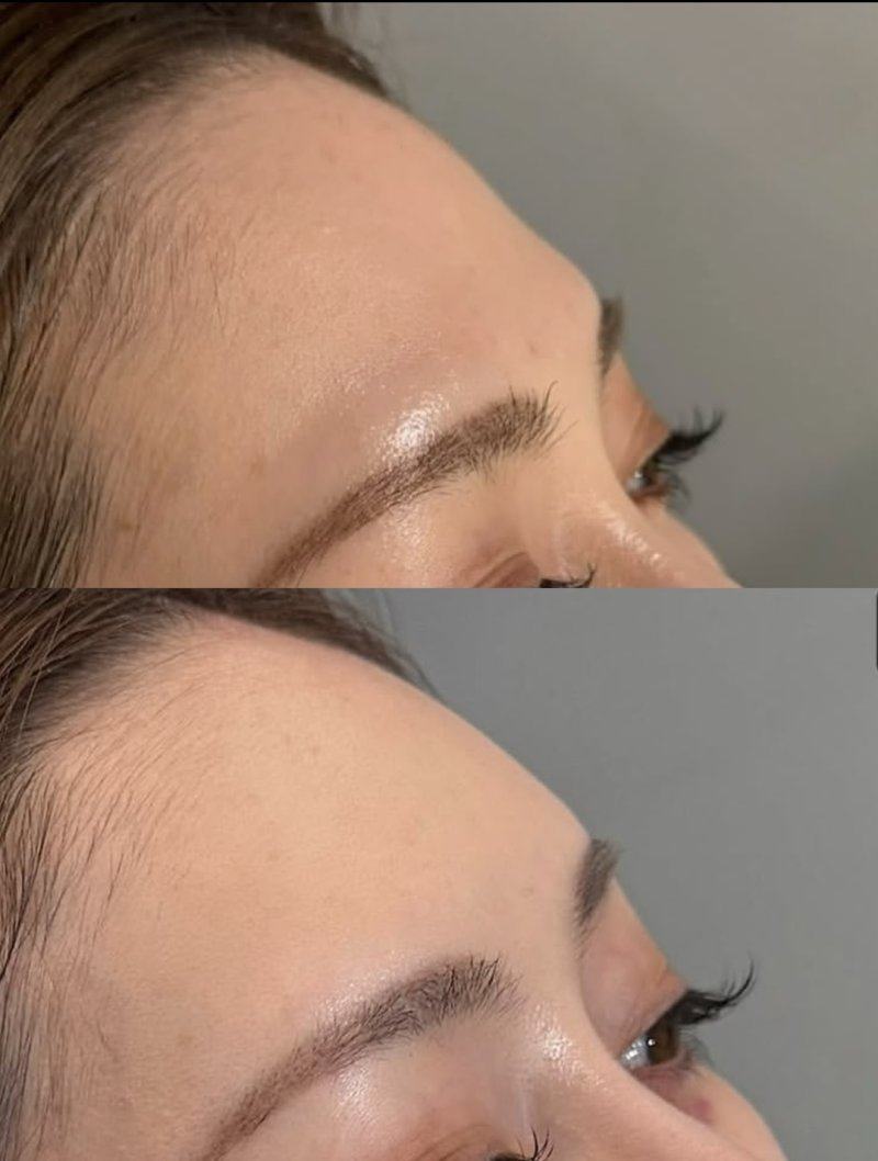 二、大腿抽脂一个月了还有点痛有硬块，该怎么区分正常与异常