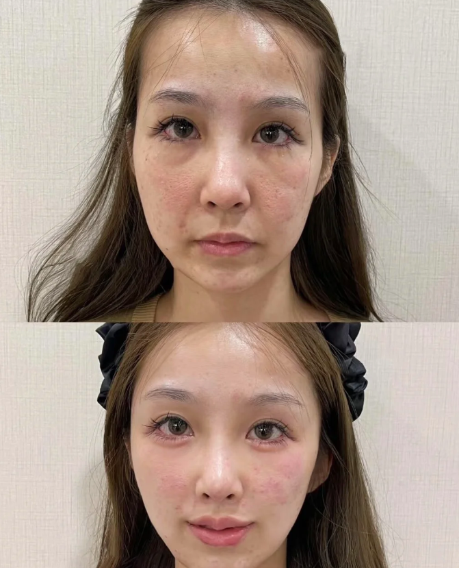 四、术后3-6个月：观察定型，等待修复时机