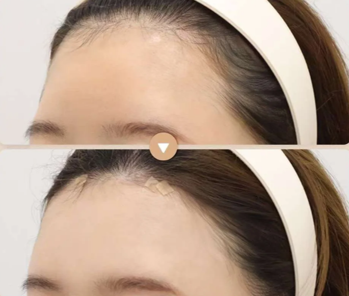 六、硬块久不消退的专精修复建议