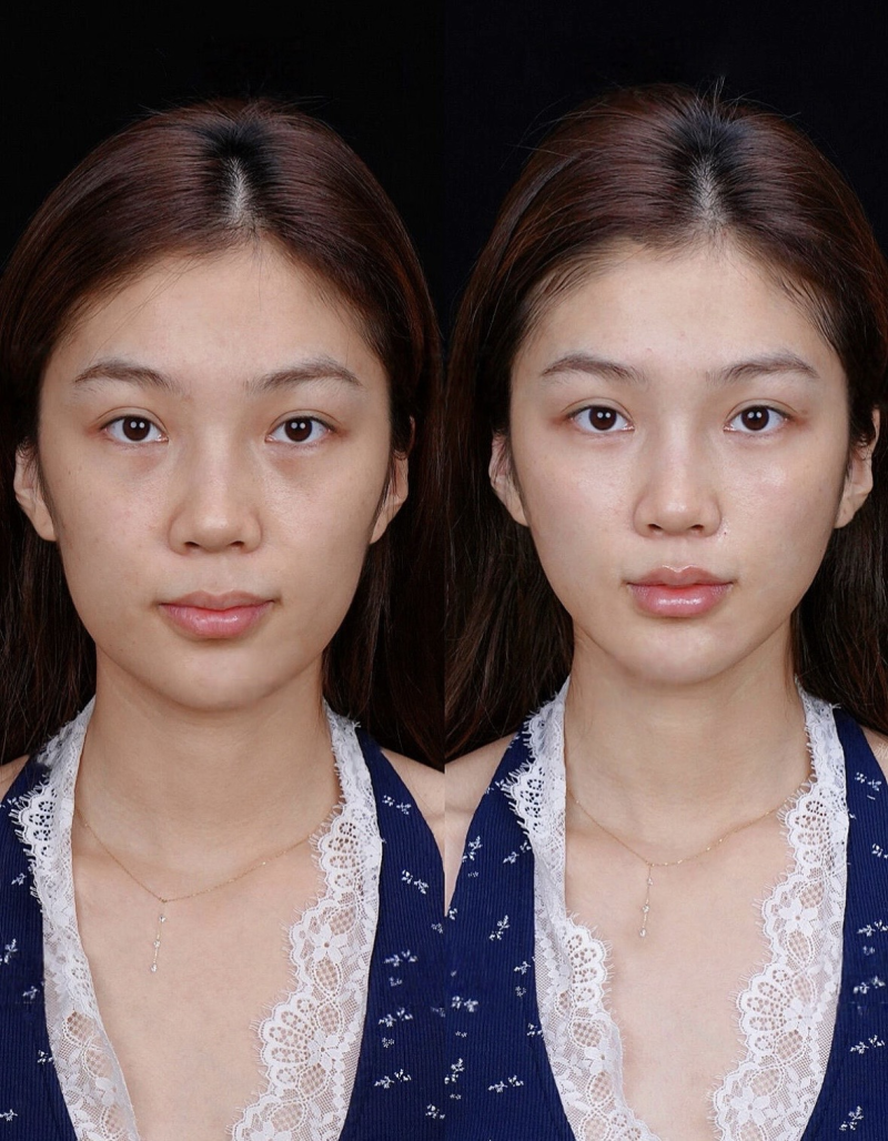 大腿抽脂一个月后还是很多硬块怎么办？附痛/肿硬/消褪/变粗解决指南