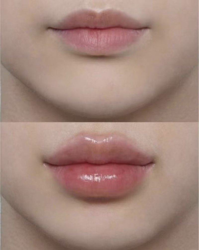 五、线提升隆鼻时间长了，到底要不要取线？