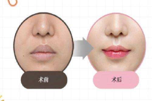 二、哪种除皱针维持时间更长