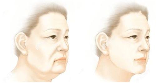 四、眼袋手术大约多长时间能修复成正常状态