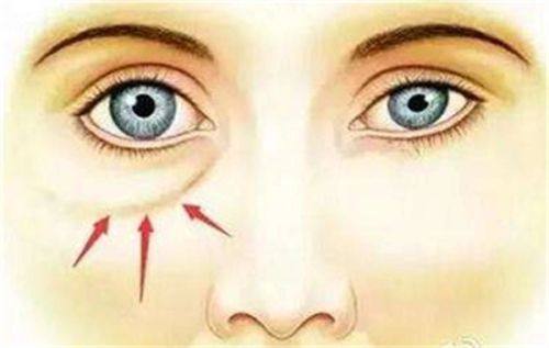 什么样的耳软骨适合隆鼻？耳甲腔/艇取材+适配人群鼻型及修复全解析