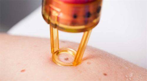 三、脸上激光祛疤的费用情况