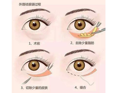 三、眼袋手术大约多长时间能消肿