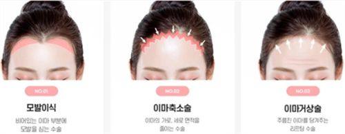 三、结合修复时间,怎么选适合自己的华美祛眼袋术式?