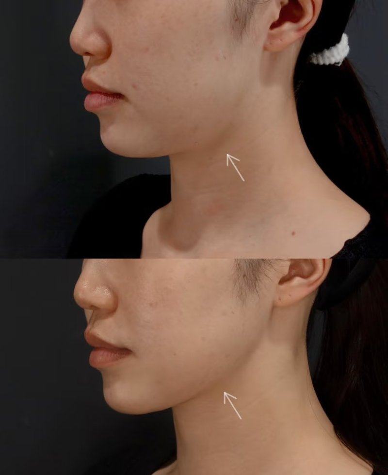 二、不同祛眼袋术式,手术时长差异大