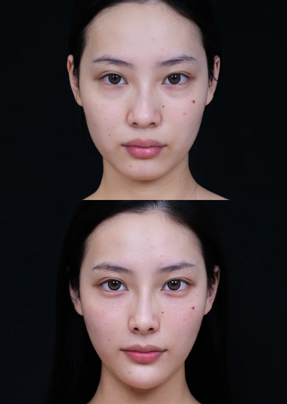 四、双眼皮术后第四天其他关键修复细节