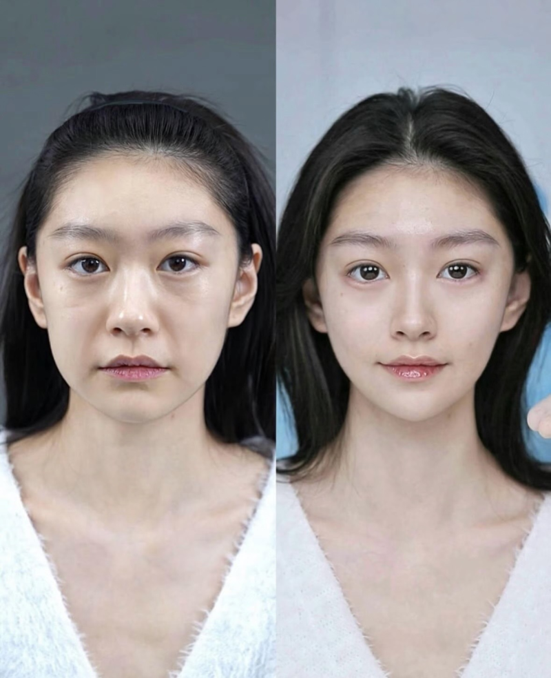 五、过度吸脂:透支身体的违规操作隐患