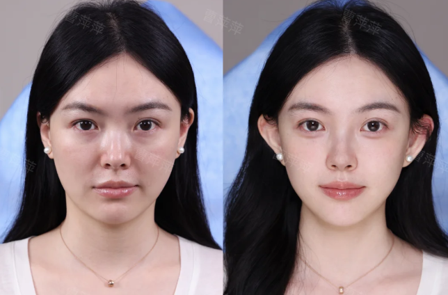 三、双眼皮术后第四天玩手机的正确方式