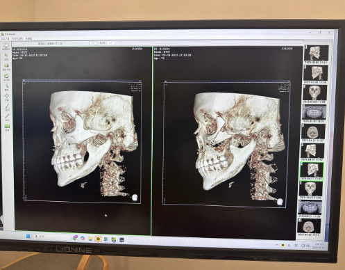 三、怎么去眼袋黑眼圈更快更有效