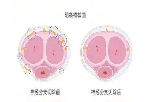 二、术后科学护理，让假体隆胸软的快一点