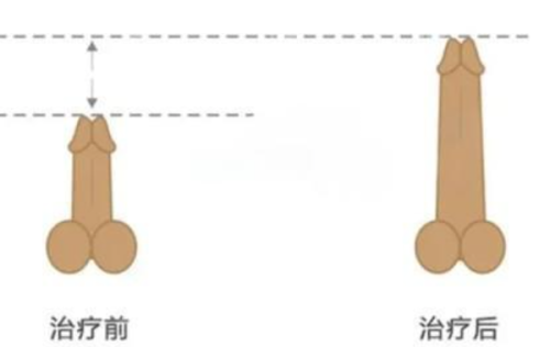 二、黄金微雕面吸后消肿节奏与修复痛感解析