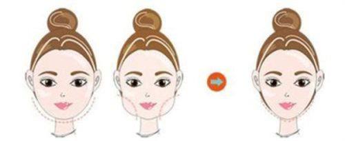 三、不同类型多层双眼皮的手术选择指南