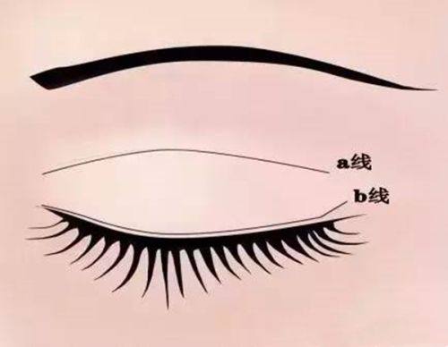 割完双眼皮多久可以不用冰敷?冰敷阶段的关键细节