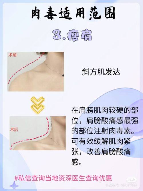 二、多层双眼皮修复中如何兼顾疤痕隐痕与线条自然