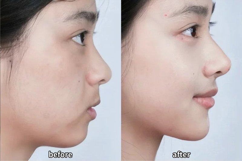 五、多层双眼皮消除后的长期维护要点