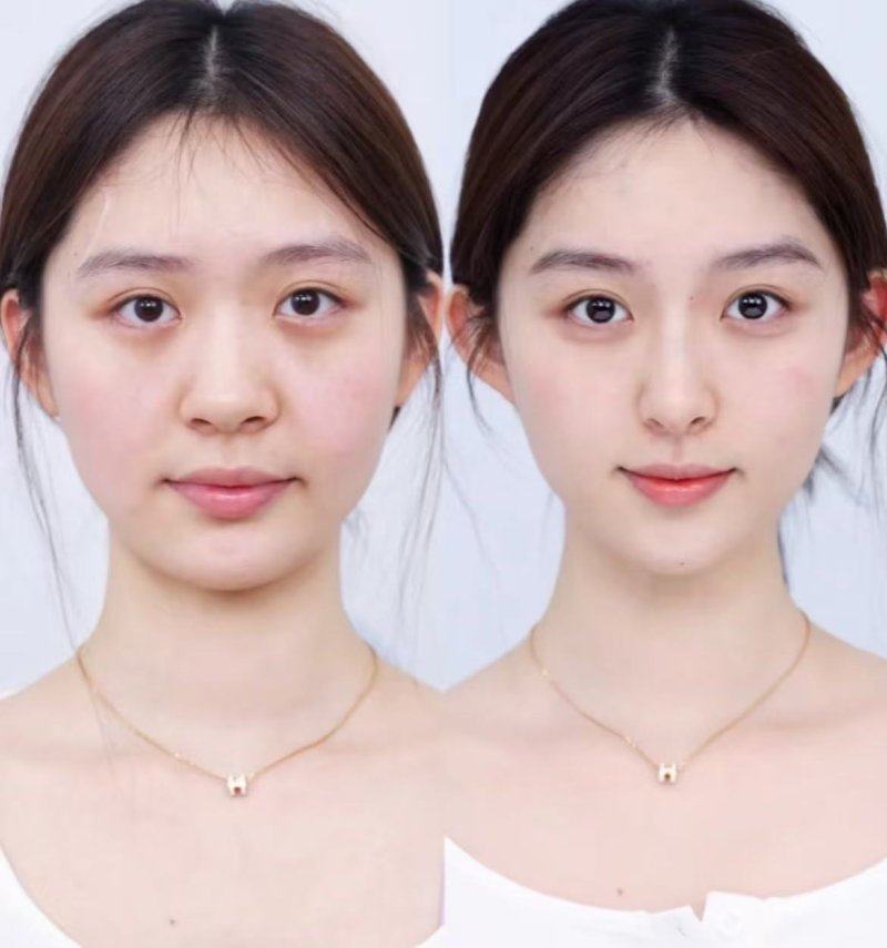 隆鼻多久可以恢复？附完全自然/最佳效果时间，全类型及修复恢复期汇总