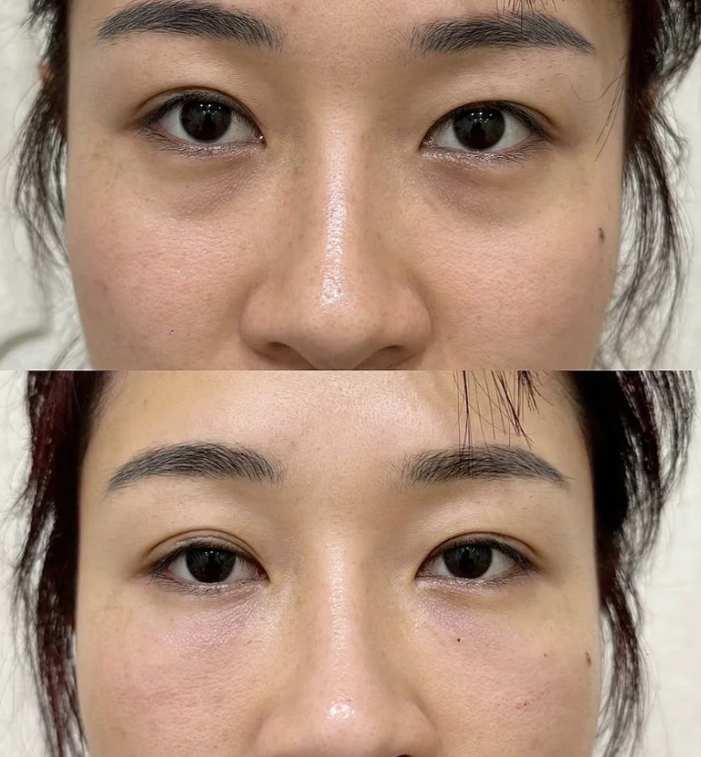 四、如何科学规避眼袋手术风险