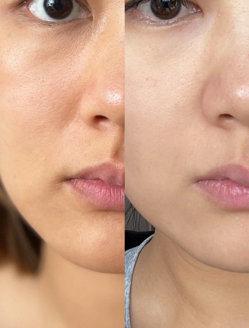 二、瘦脸针隔多久打一次合适：安心是第一前提