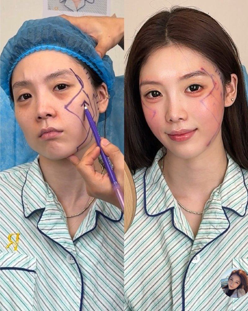 热敷的正确操作方法及注意事项