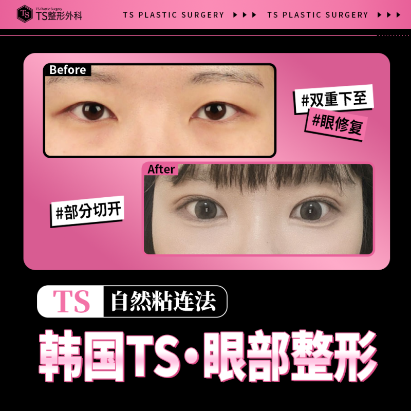 二、膨体耳软骨隆鼻的维持时间范围