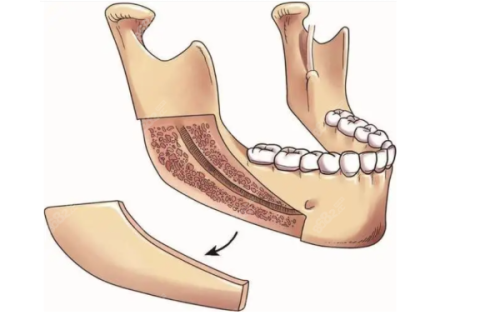 隆鼻一个月稳定了吗？会不会移位？不同材料恢复进度与自然度解析