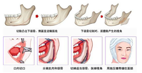 五、第二次隆鼻会比第一次贵吗