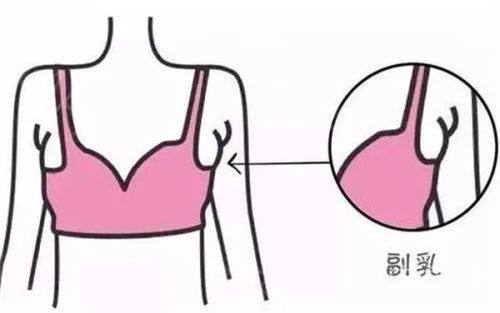 四、隆鼻一个月是不是就自然了