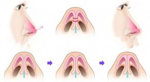 二、双眼皮后疤痕增生能去掉吗?规范干预可实现淡化甚至消失