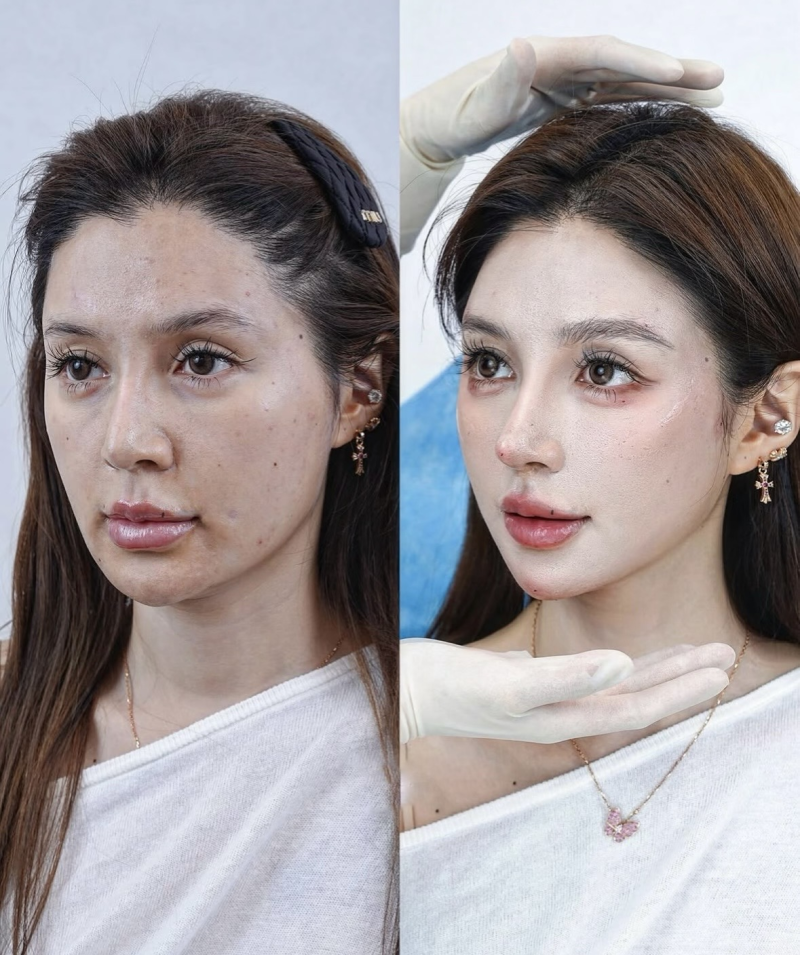 二、隆鼻一个月会不会移位