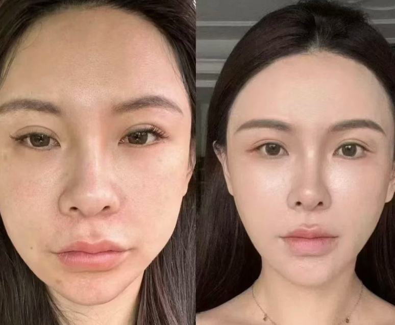 三、第二次隆鼻要重新剥离吗