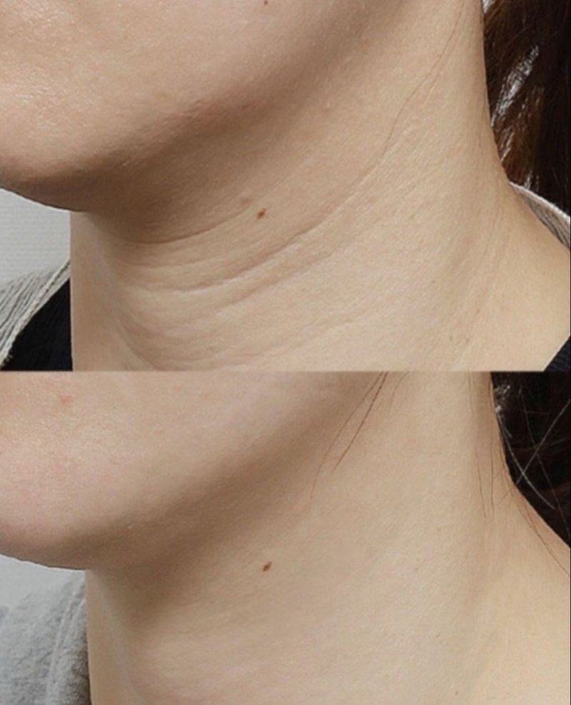 五、疤痕增生又红又痒能治好么