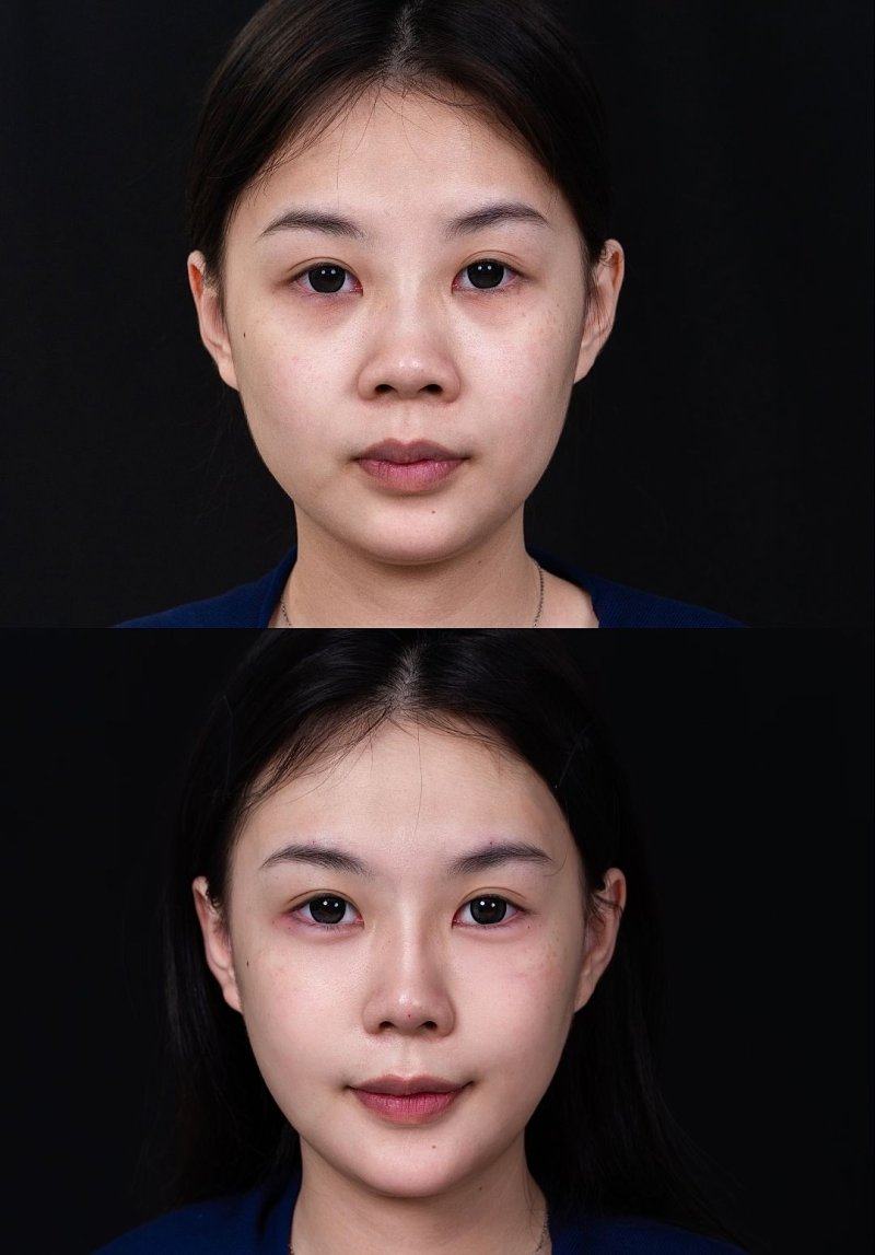 二、眼袋大黑眼圈重:多重因素的叠加效应