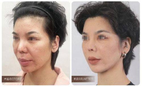 三、手术类方法：顽固眼袋的有效解决途径