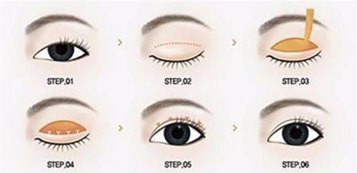 四、特殊眼袋情况的针对性处理